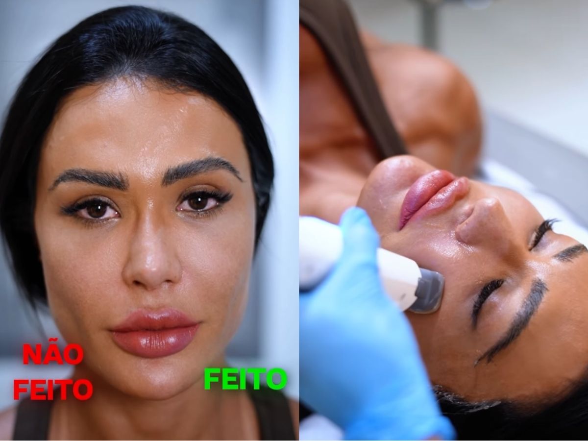 Mudança radical! Gracyanne Barbosa surpreende ao reverter procedimentos