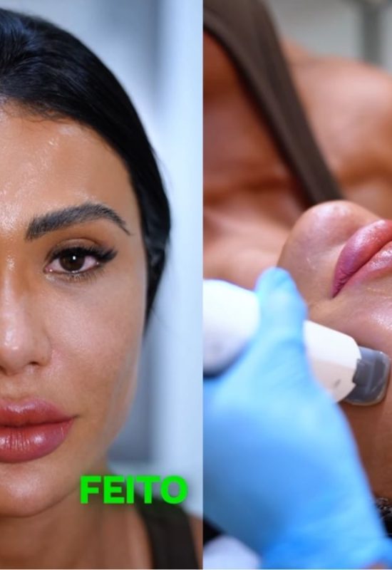 Mudança radical! Gracyanne Barbosa surpreende ao reverter procedimentos